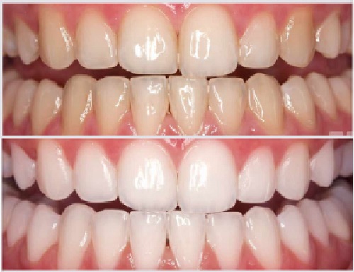 denti prima e dopo trattamento con iA-Brush