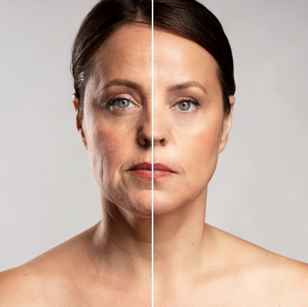 viso di donna con pelle prima e dopo il trattamento con Fast Lifting