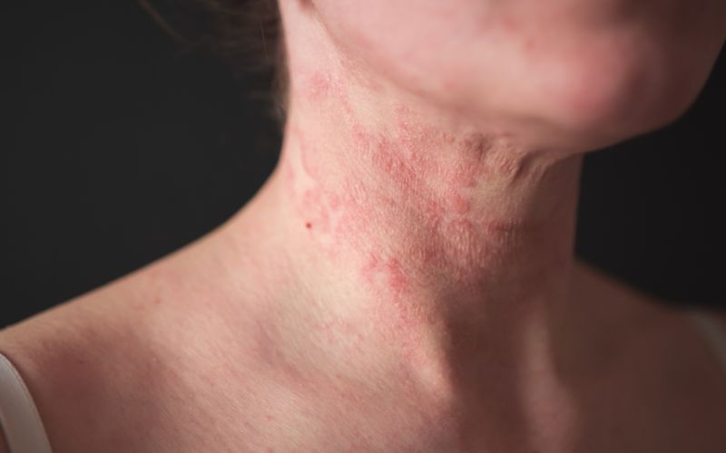 donna con la dermatite seborroica al collo