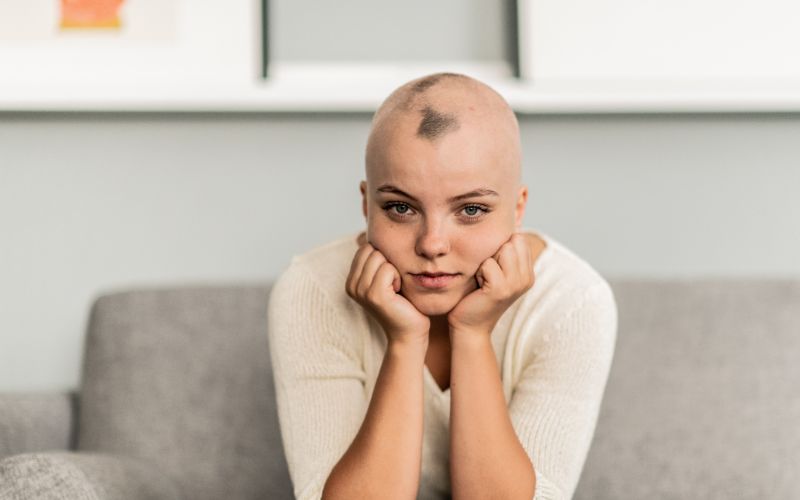 alopecia femminile come funziona