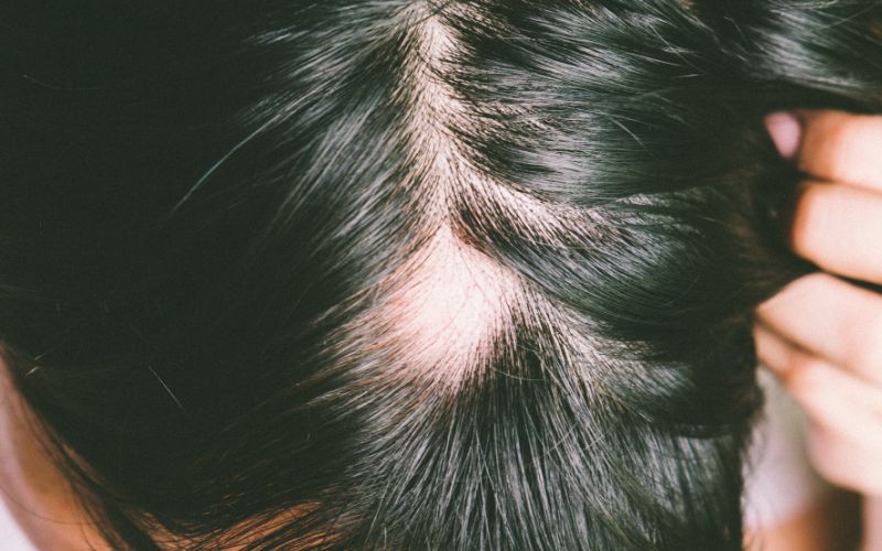 sintomi dell'alopecia androgenetica